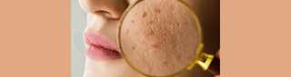 Skin Care: Actinic Keratosis