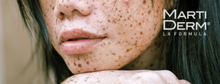Skin hyperpigmentation